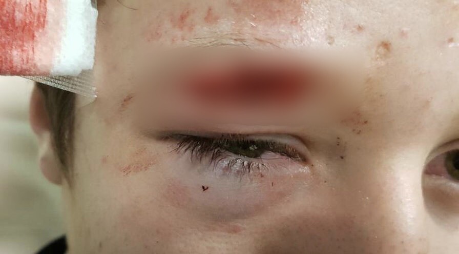 Montpellier : Un ado de 14 ans blessé d’un coup de couteau au visage en défendant un enfant de 11 ans.