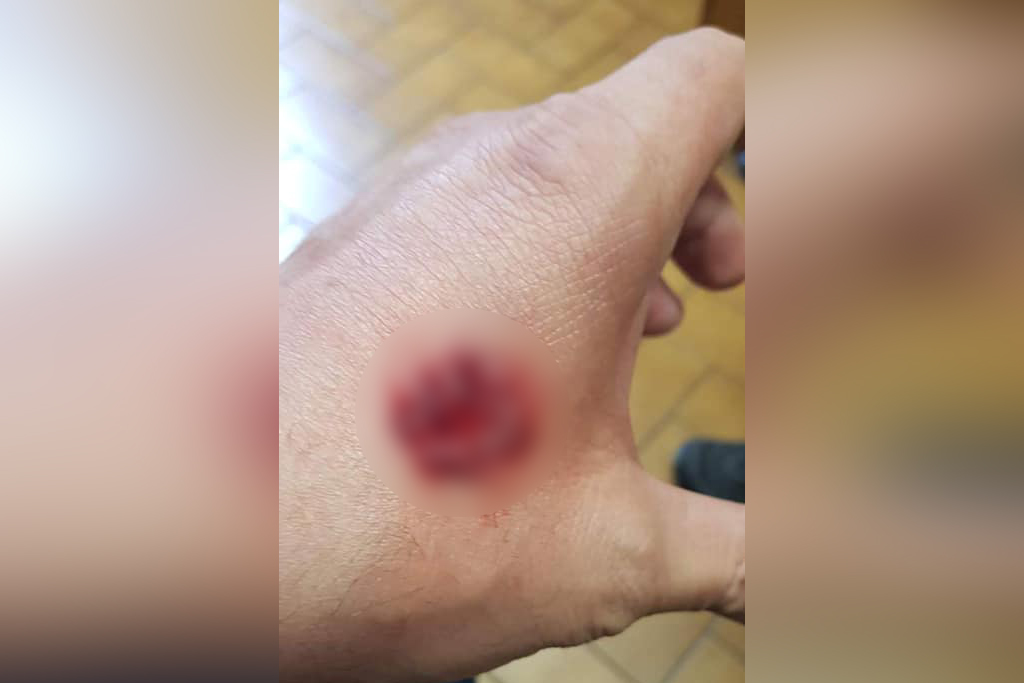 Nice : Un homme mord un policier jusqu'au sang lors d'un contrôle du confinement