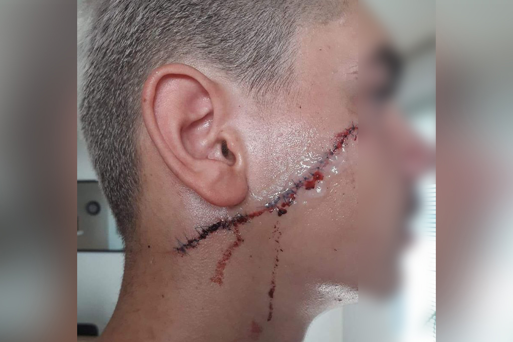 Montpellier : Un ado de 15 ans défiguré au couteau et roué de coups pour des baskets et une sacoche