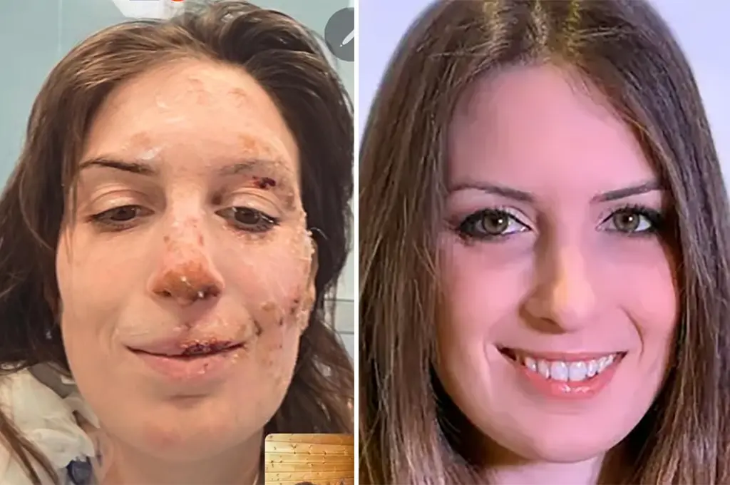 Rescapée de Crans-Montana, Eleonora Palmieri publie une photo de son visage brûlé : «N'arrêtez jamais d'honorer la vie»